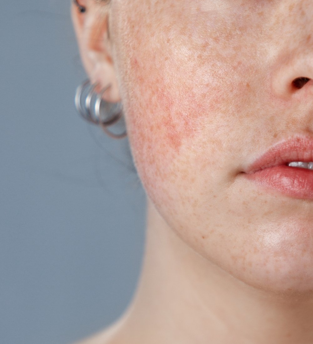 Rosacea och hudvård? Så skapar du din hudvårdsrutin