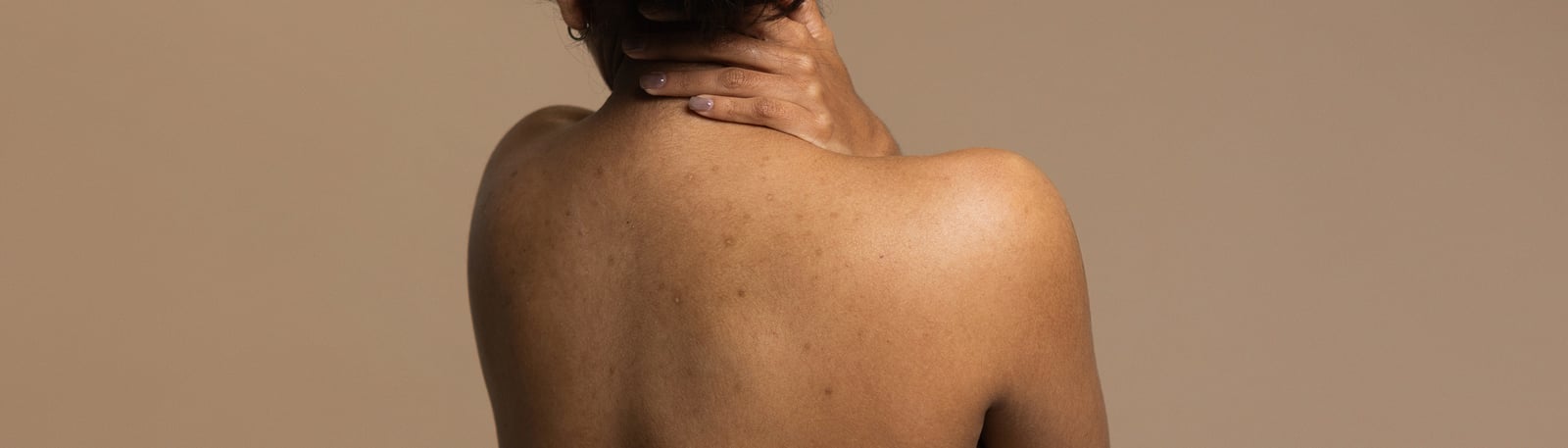 Finnar på rygg och bröst? Så blir du av med kroppsakne