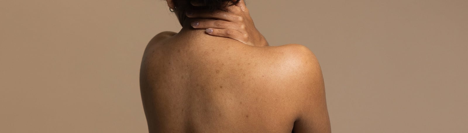 Finnar på rygg och bröst? Så blir du av med kroppsakne