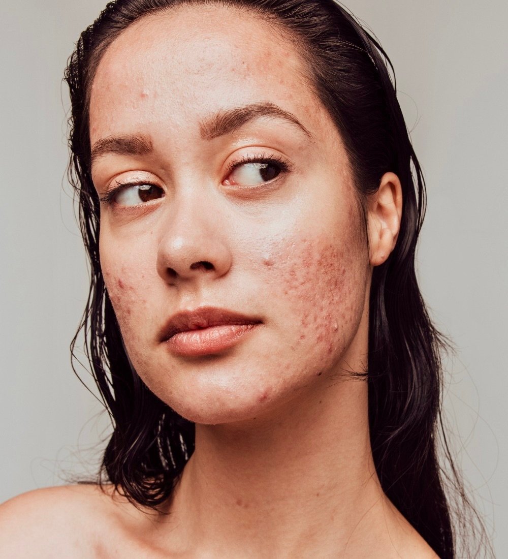 Dermatologen: Så tar du hand om aknebenägen hud