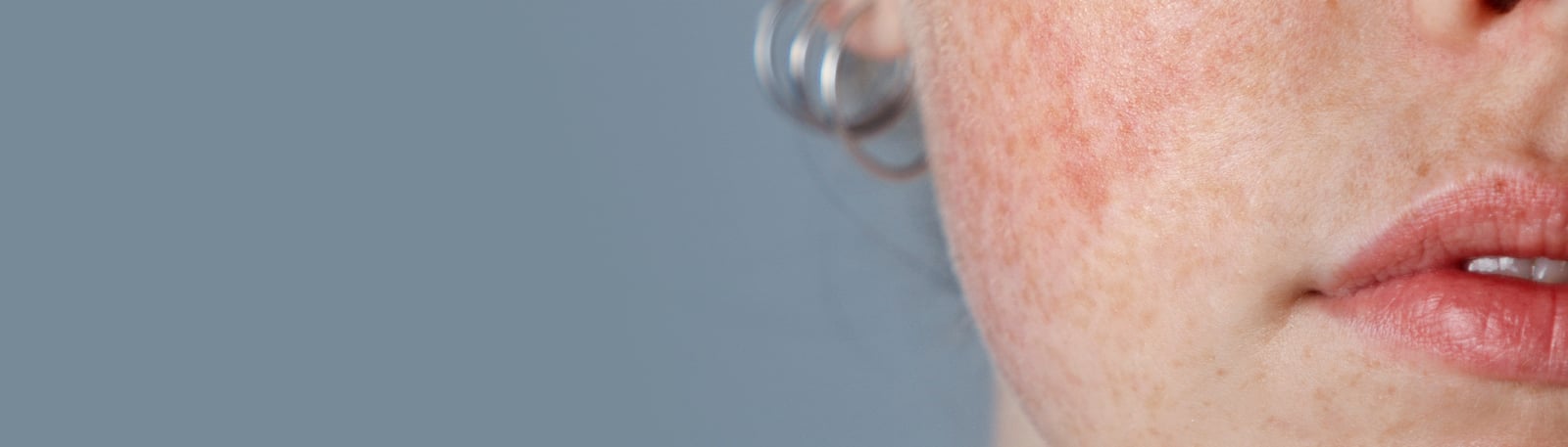 Rosacea och hudvård? Så skapar du din hudvårdsrutin
