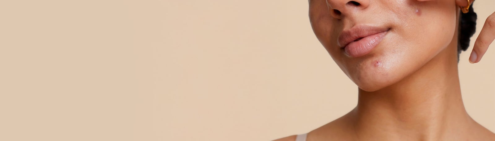 Akne? Så motverkar du torr hud vid uttorkande behandlingar