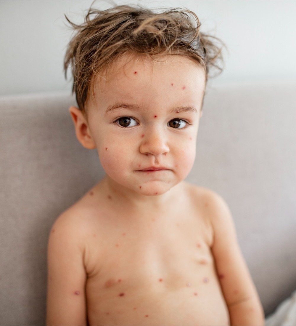 Tips när ditt barn fått vattkoppor – Farmaceuten guidar