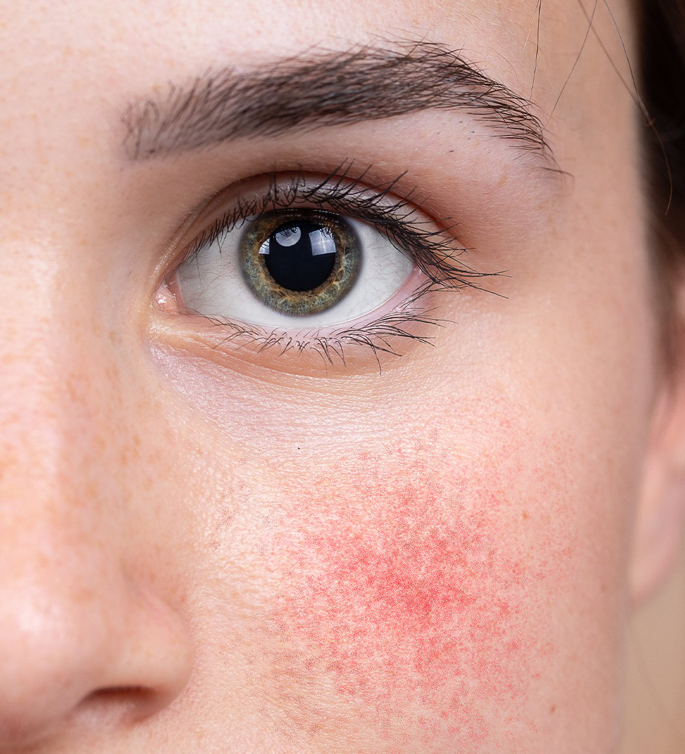 Hudterapeuten guidar: Allt om rosacea och hur du behandlar 