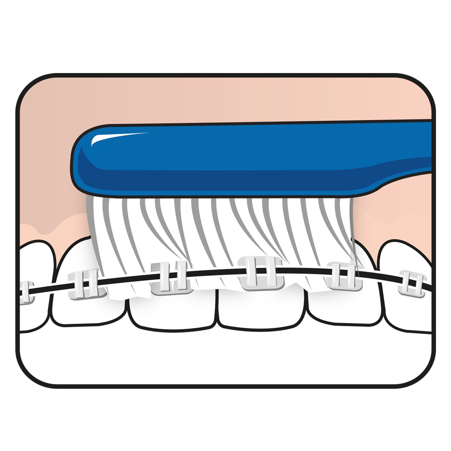 TePe Implant Orthodontic Brush Tandborste 1-pack