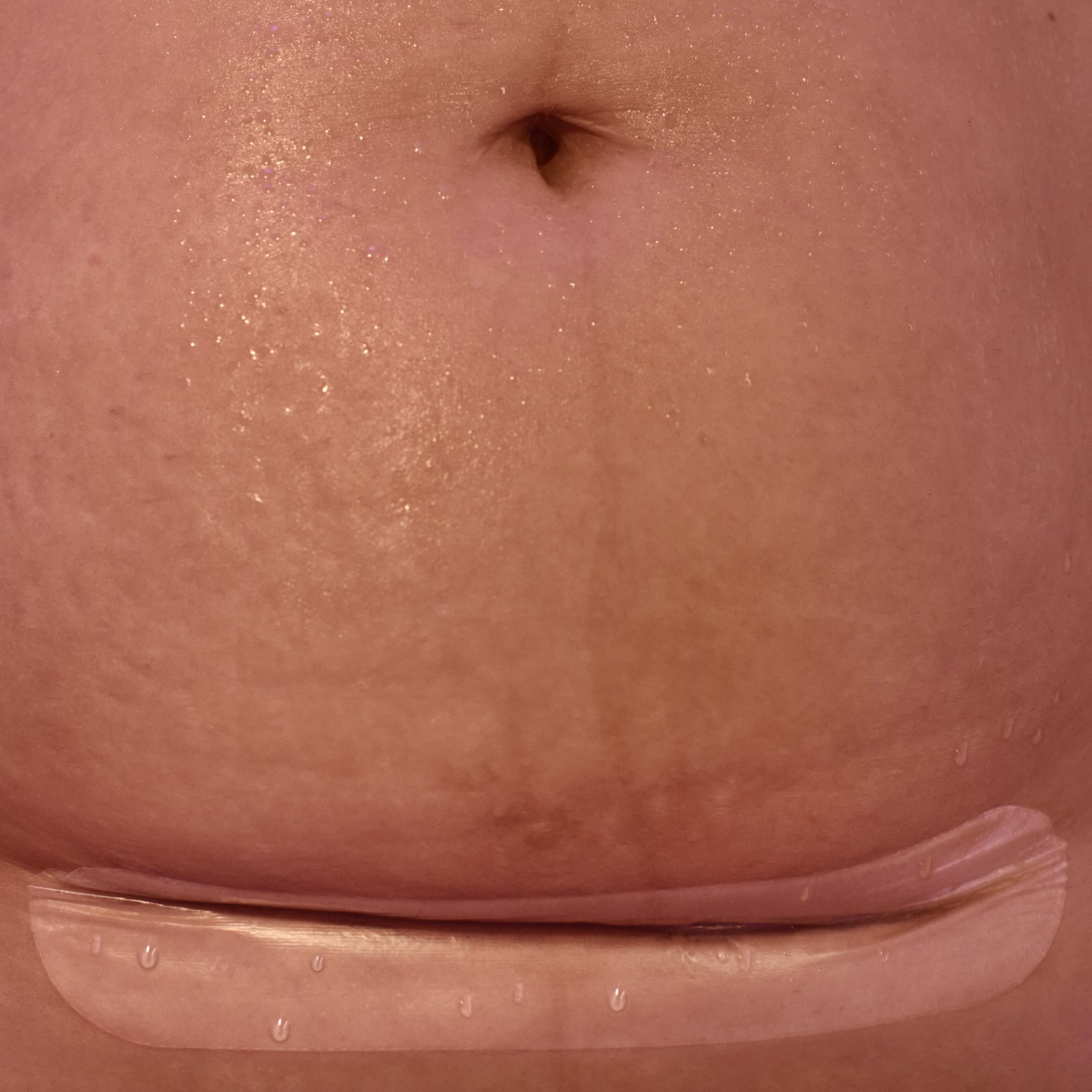 Frida Mom Ärrplåster i silikon för kejsarsnitt, 6st