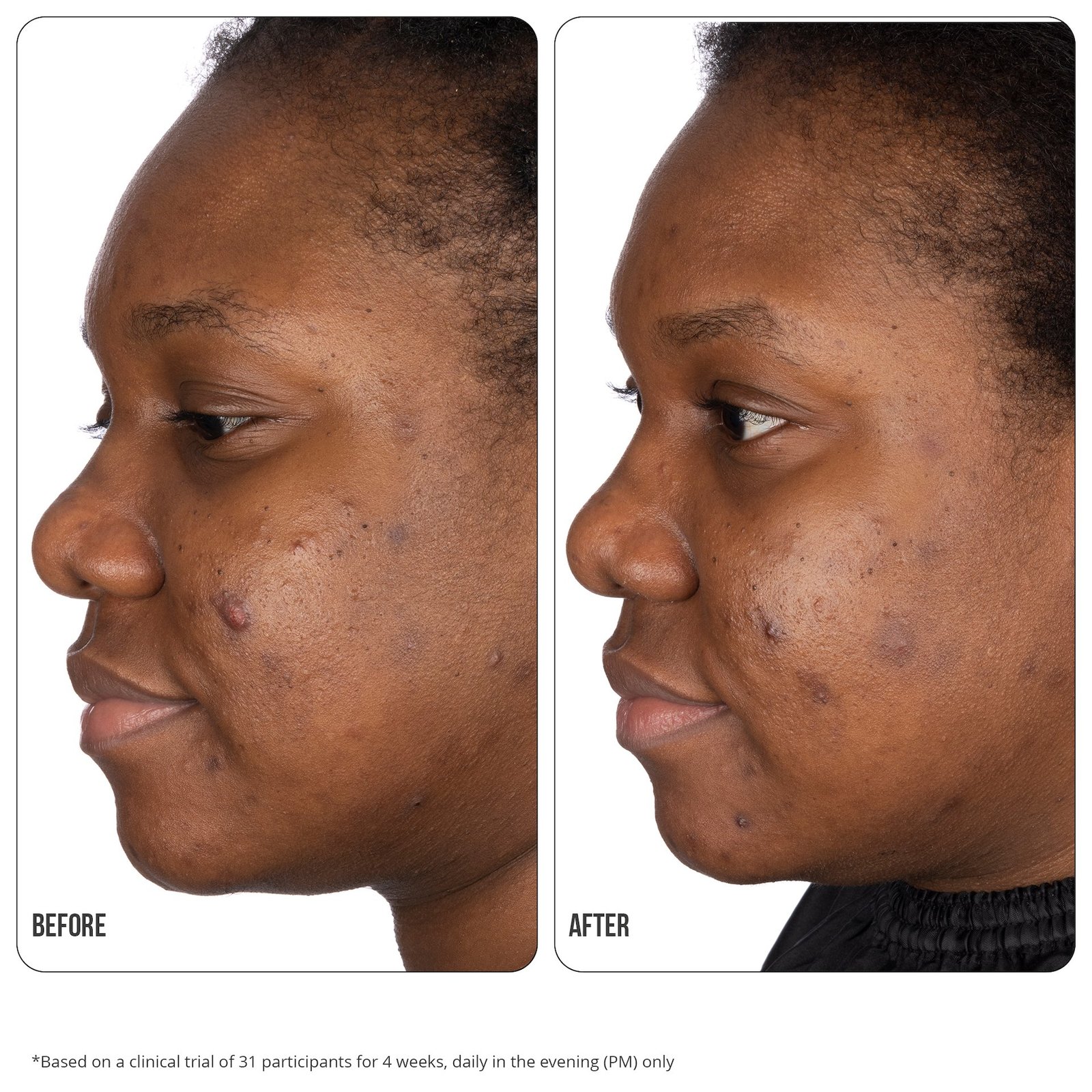 NIP+FAB Retinol Fix Blemish Gel 15 ml