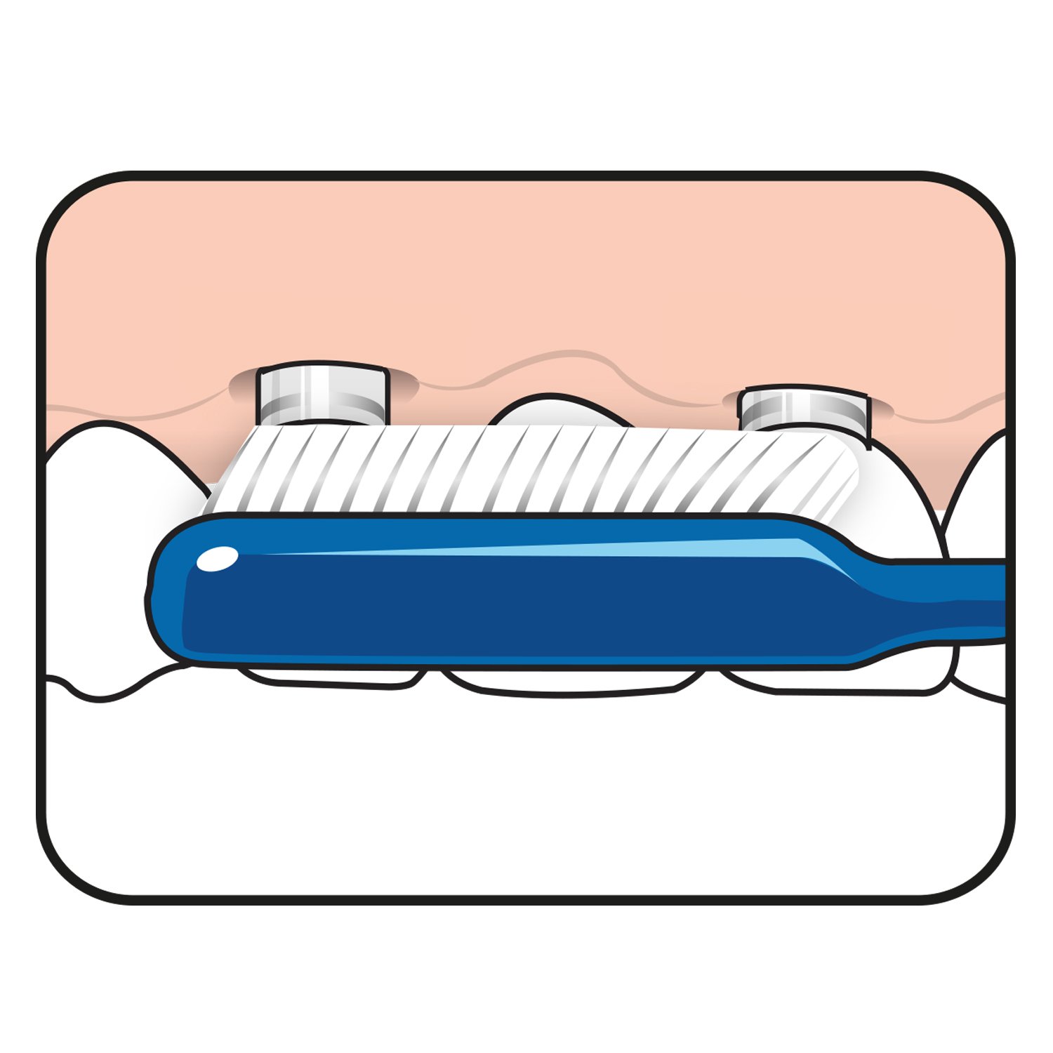 TePe Implant Orthodontic Brush Tandborste 1-pack