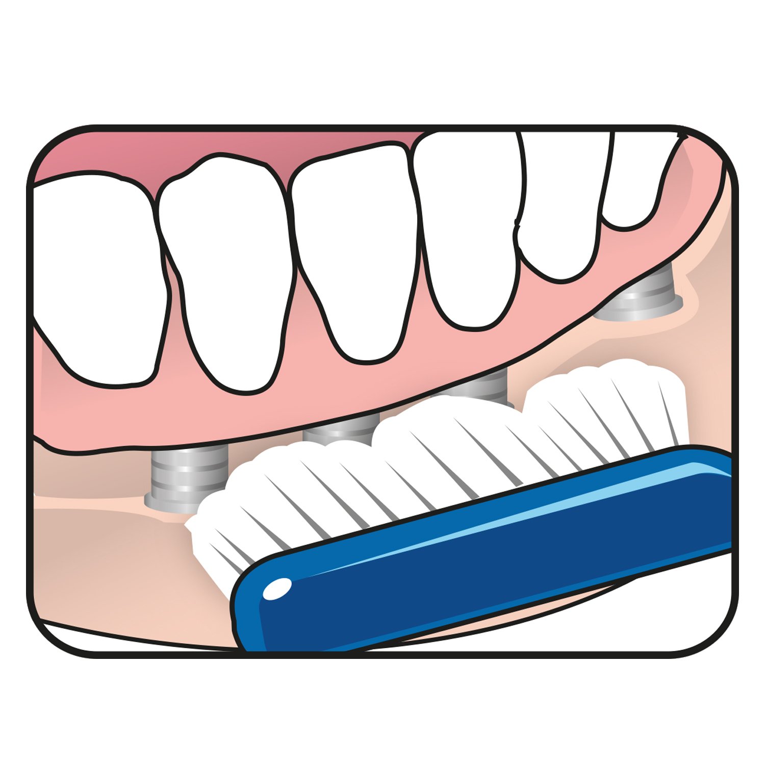 TePe Implant Orthodontic Brush Tandborste 1-pack