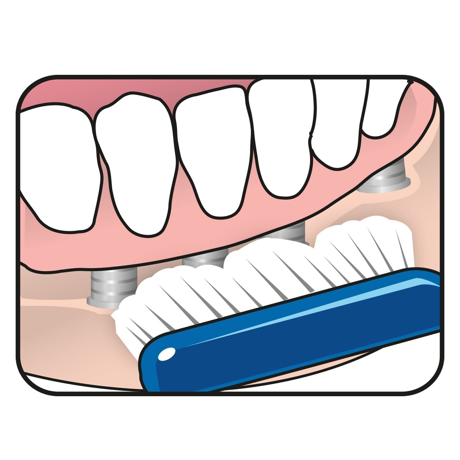 TePe Implant Orthodontic Brush Tandborste 1-pack