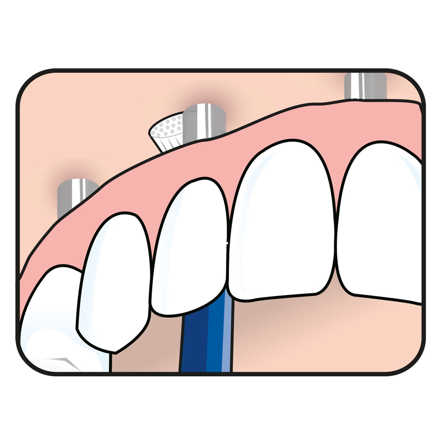 TePe Universal Care Vinklad borste 1-pack