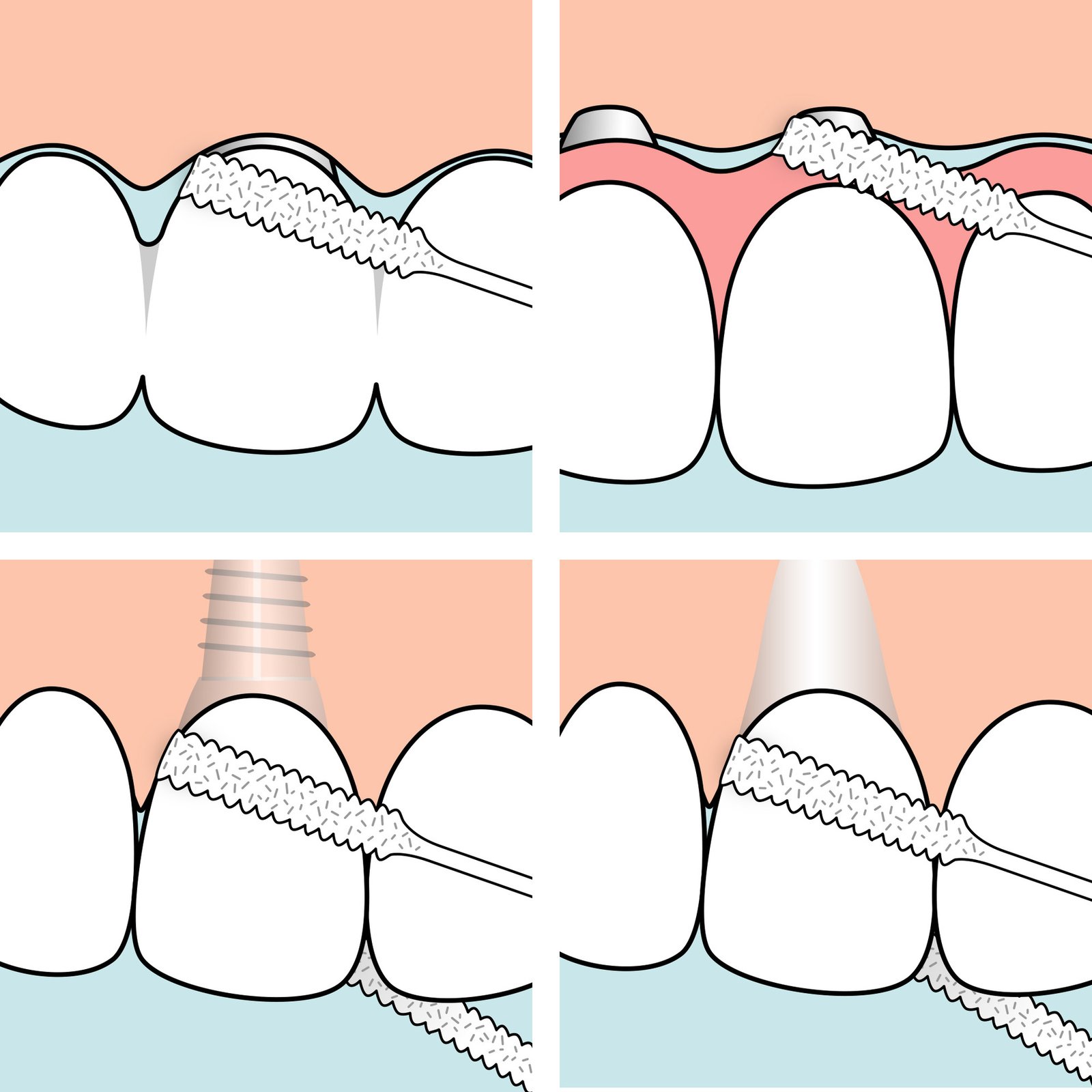 TePe Bridge & Implant Floss 30 st