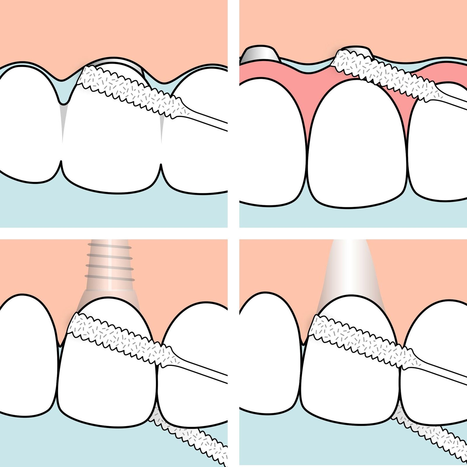 TePe Bridge & Implant Floss 30 st