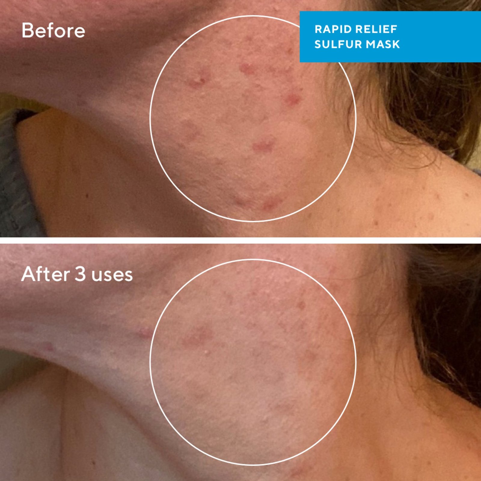 Murad Rapid Relief Sulfur Mask 75 ml