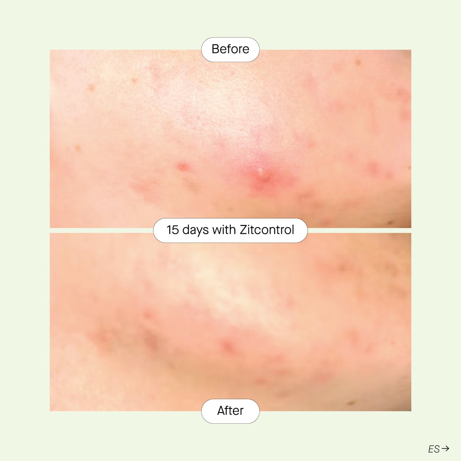 Niche Beauty Lab Acnemy Zitcontrol 40 ml