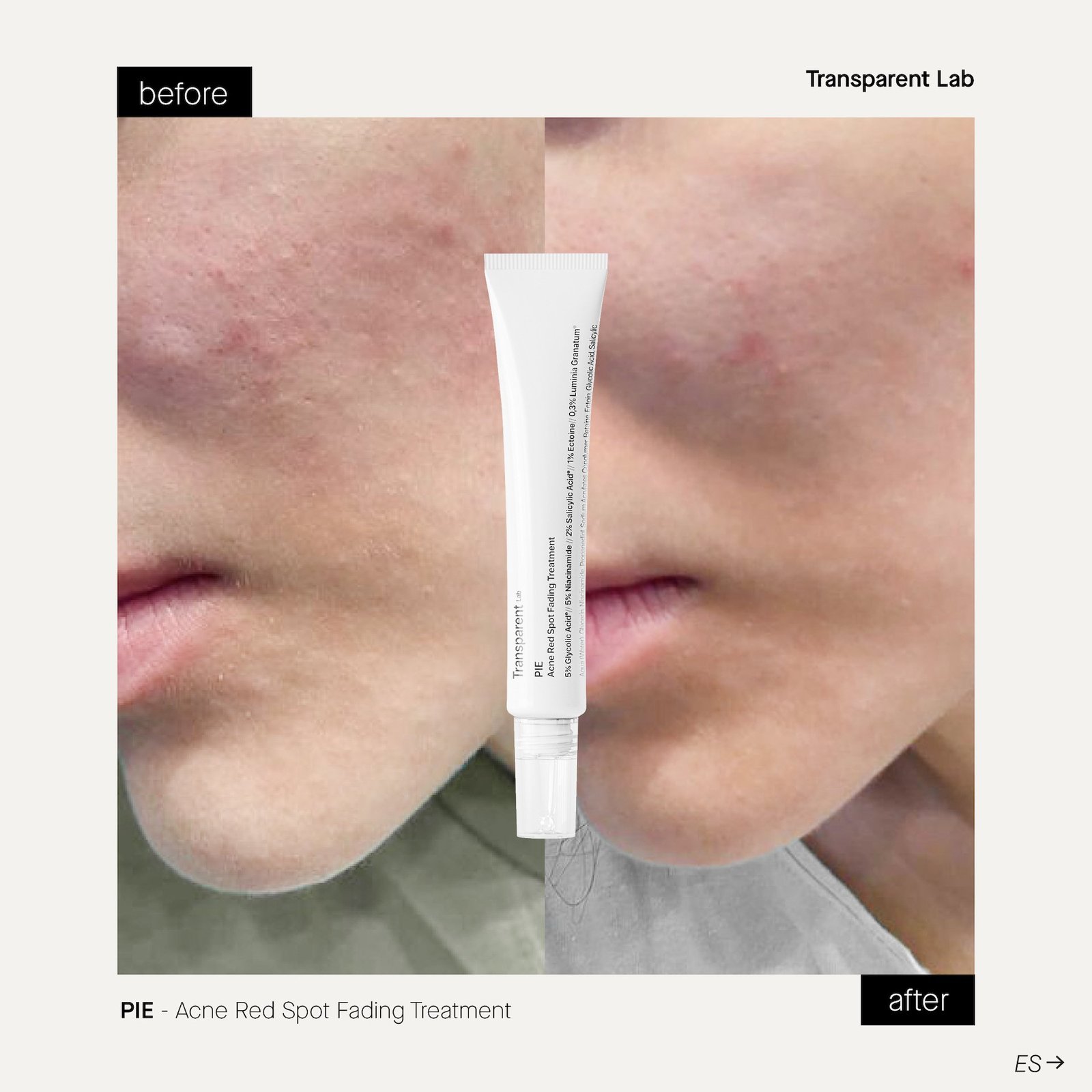 Niche Beauty Lab Transparent P.I.E Acne Red Spot Fading Treatment 30 ml