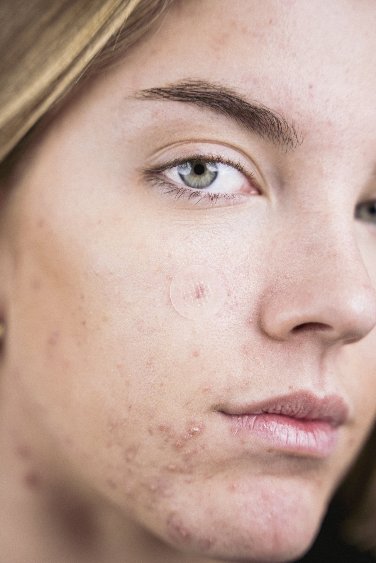 Niche Beauty Lab Acnemy Zitless Patches 5 st