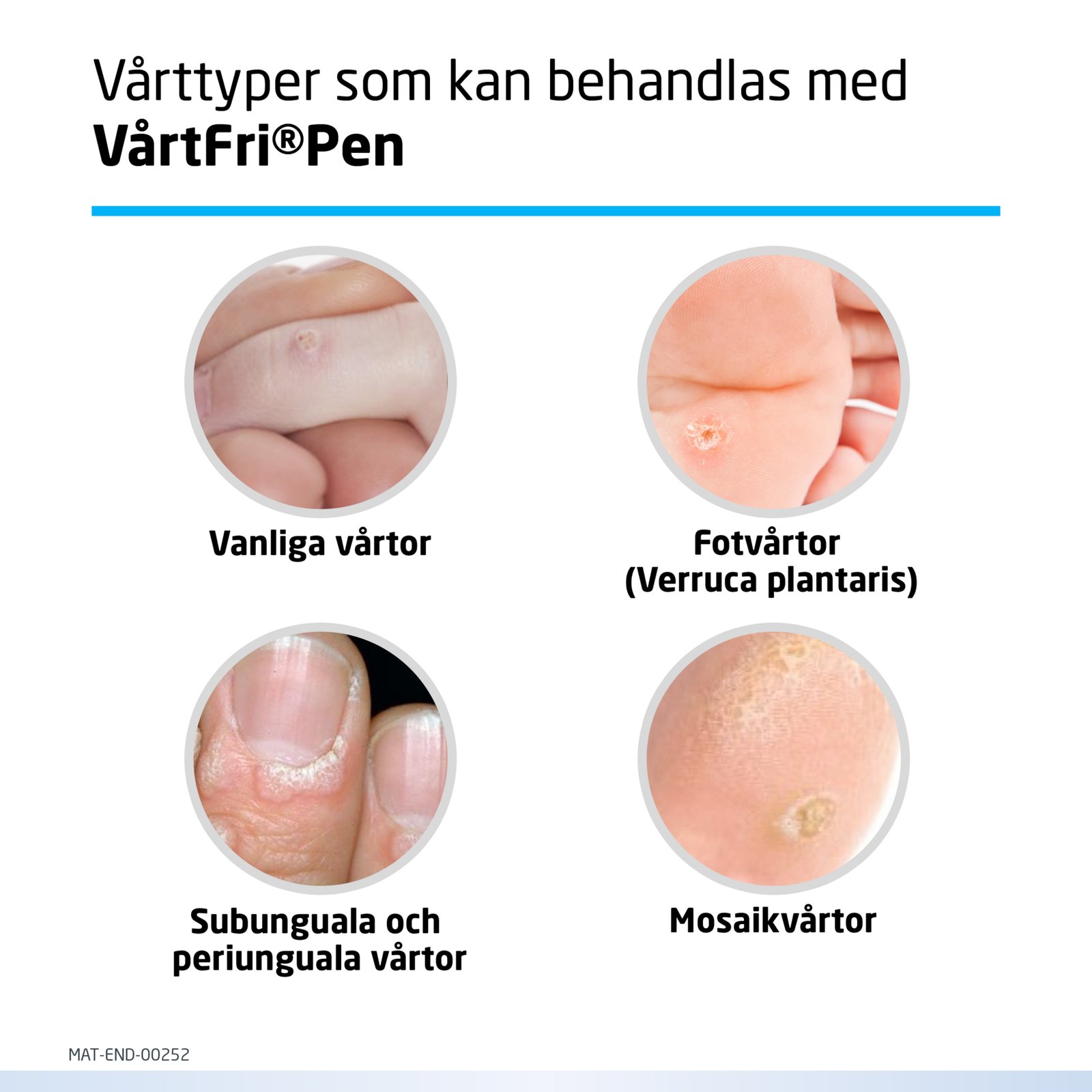 VårtFri Pen 30 behandlingar